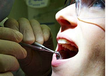 Sugar affect dental health